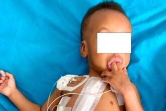 La storia della piccola Adonai del Burundi, operata con successo al cuore presso la cardiochirurgia pediatrica di Taormina
