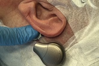 Il Policlinico di Palermo è il primo in Italia ad impiantare SENTIO di Oticon per la sordità, migliorando la qualità della vita dei pazienti