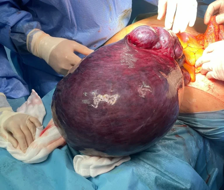 fibroma utero